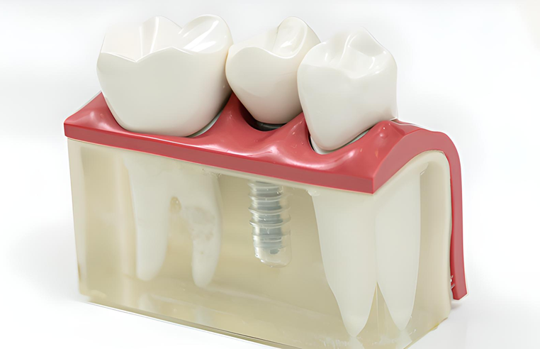 先進的な診断機器と高品質素材を活用した信頼性の高いインプラント治療