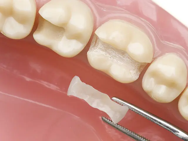 金属を使わないセラミック素材を用いた、金属アレルギーの心配がない審美的な治療