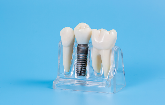 噛む力を取り戻すための精密なインプラント治療を提供